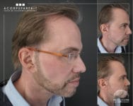 La micropigmentation capillaire: qu’est-ce que c’est ?
